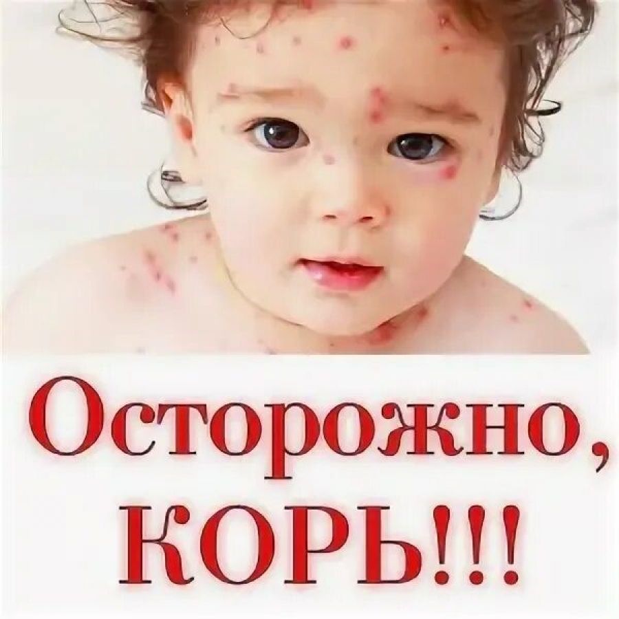 Корь подтвердилась у девочки в Забайкалье 