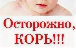 Корь подтвердилась у девочки в Забайкалье 