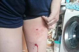 Собака напала на 10-летнего мальчика и прокусила ему ногу на «Зенитке» в Чите