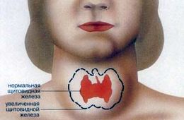Эндемический зоб — главная детская болезнь в Забайкальском районе