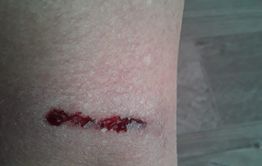 На читинку напала свора собак в поселке Аэропорт