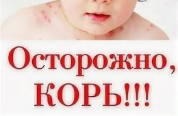 Корь подтвердилась у девочки в Забайкалье 