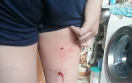 Собака напала на 10-летнего мальчика и прокусила ему ногу на «Зенитке» в Чите