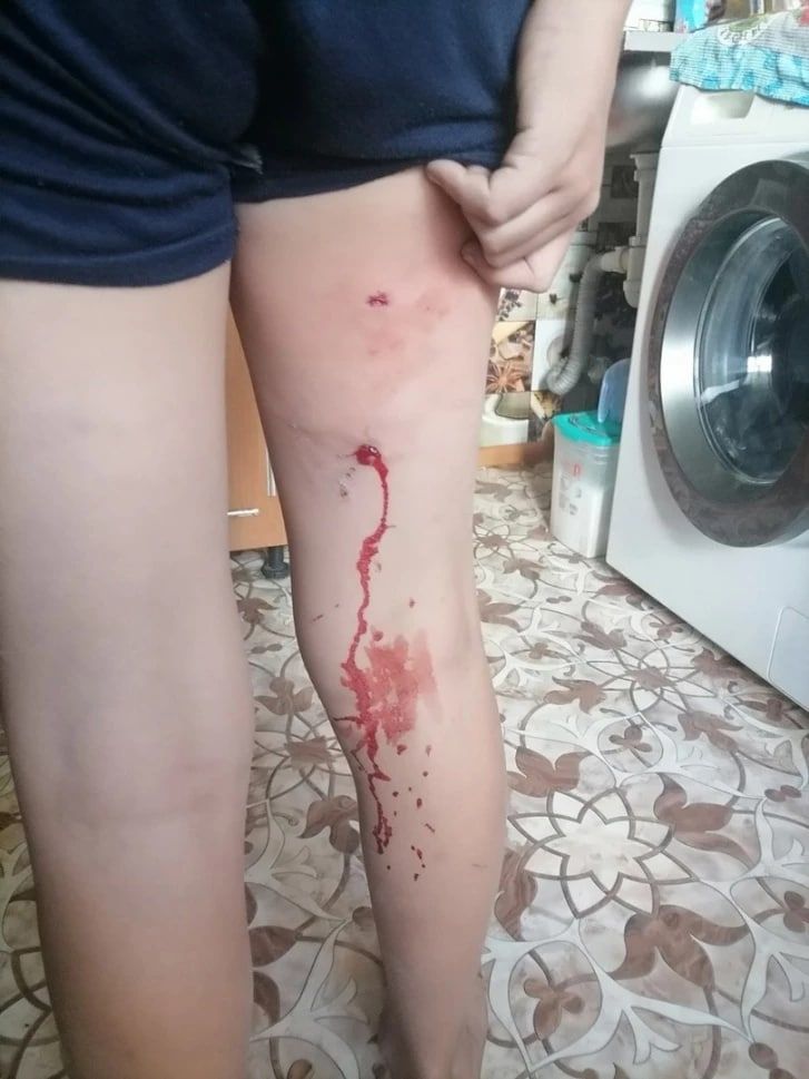 Собака напала на 10-летнего мальчика и прокусила ему ногу на «Зенитке» в Чите